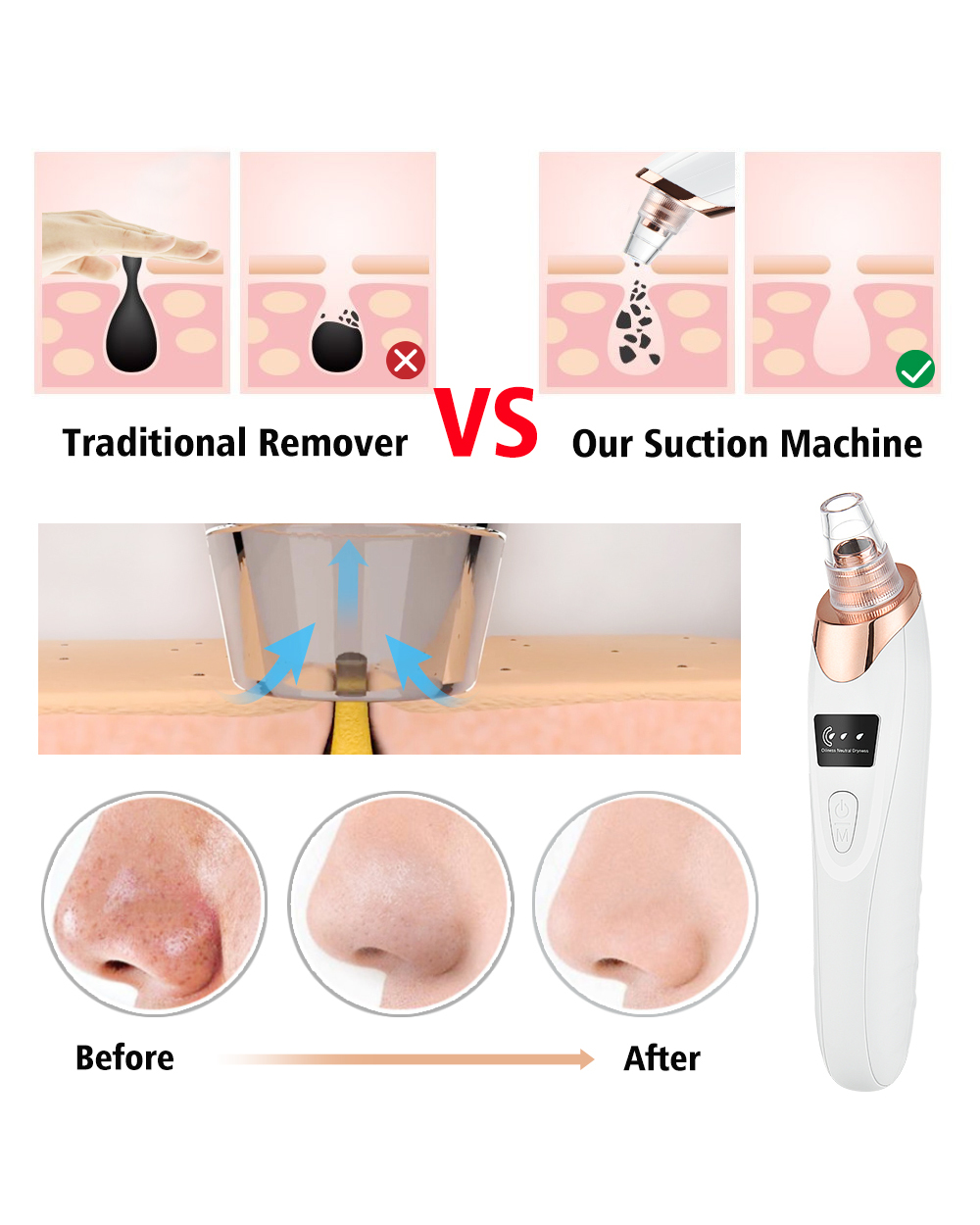 Blackhead Remover Vacuum front-2